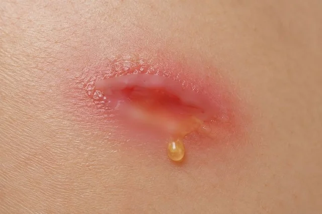 EXUDADO EN HERIDAS 