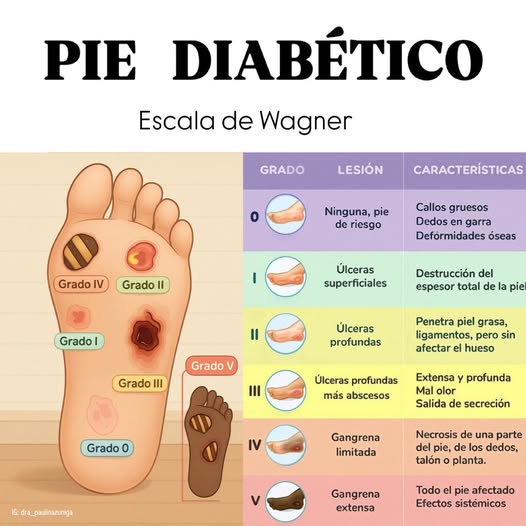 GRADOS DE LESIÓN DEL PIE DIABÉTICO 